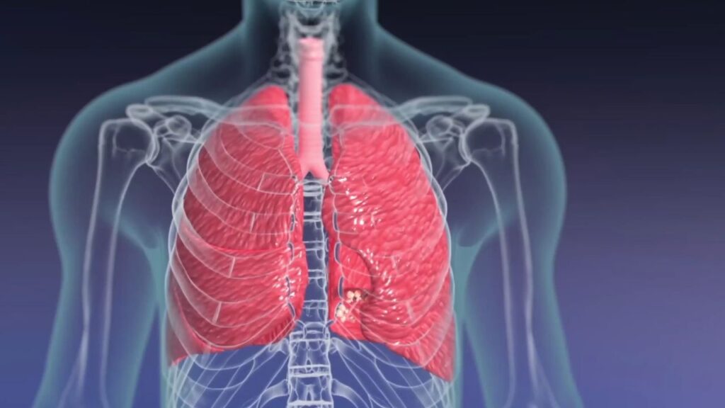 Your lungs play a vital role in keeping your body functioning properly by supplying oxygen and removing carbon dioxide. However, factors like pollution, smoking, and poor lifestyle choices can compromise lung health. Keep your lungs healthy