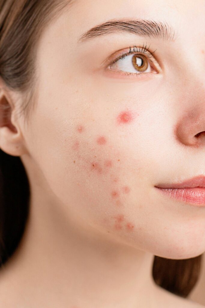 Acne scars can be a frustrating reminder of past breakouts, but the good news is that there are natural remedies for acne scars that can help reduce their appearance. If you're looking for safe, affordable, and chemical-free solutions, this guide will walk you through the best remedies for acne scars. Let’s dive in! remedies for acne